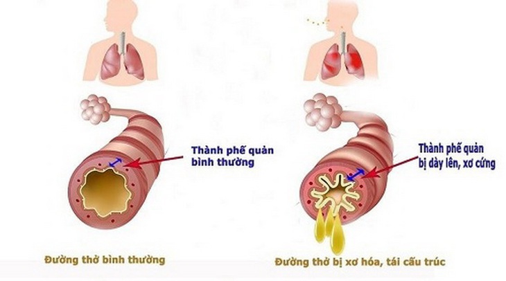 Quá trình xơ hóa, tái cấu trúc đường thở là nguyên nhân cốt lõi gây ra các bệnh đường hô hấp, trong đó có hen và COPD.